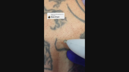 Advanced Plasma Pen Tattoo, Mole, Freckles and Skin Tag Eraser